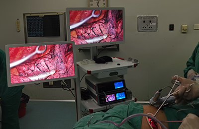 [Thoracoscopic Surgery in Thoracic Surgery] 4K ultra-high-definition thoracoscopic left upper lobectomy