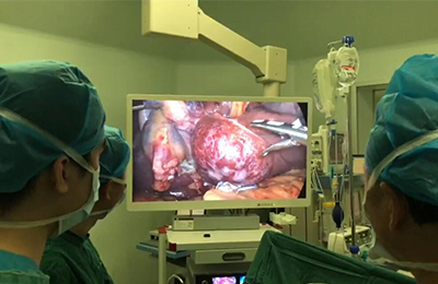 [Thoracoscopic Surgery in Thoracic Surgery] 4K ultra-high definition thoracoscopic lung volume reduction surgery
