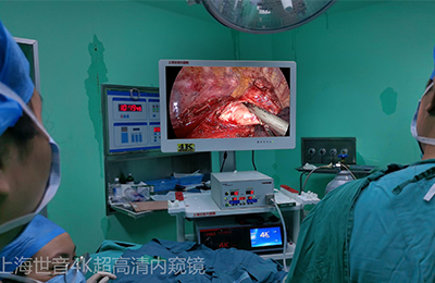 [Thoracoscopic Thoracic Surgery] 4K ultra-high definition thoracoscopy for mediastinal tumor resection