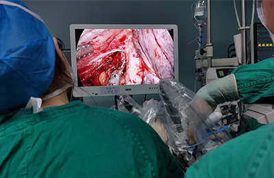 [Thoracic Surgery and Thoracoscopy] 4K ultra-high definition chylothorax surgery