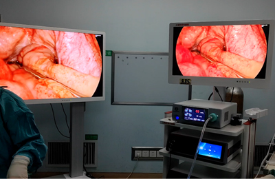 [General Surgery Laparoscopy] 4K ultra-high definition laparoscopic repair of gastric and duodenal perforation