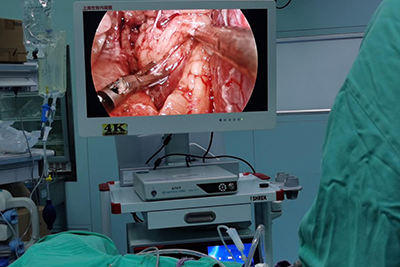 [General Surgery Laparoscopy] 4K ultra-high definition laparoscopic deroofing and decompression of renal cysts