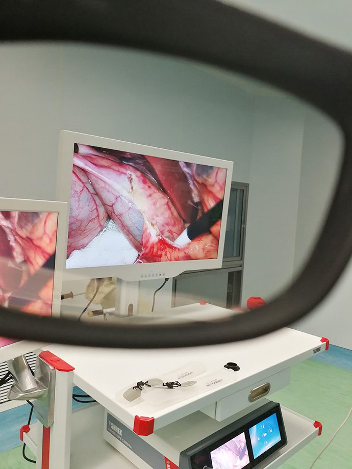 3D Laparoscopic Surgery