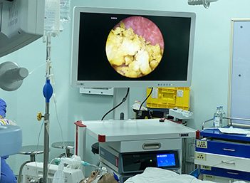 Medical FHD Endoscope Camera Gallery