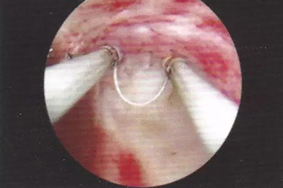 【Hysteroscope】High-frequency Electrosurgical Unit Cutting Method