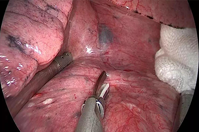 【Thoracoscopy】Detailed Tunnel Method